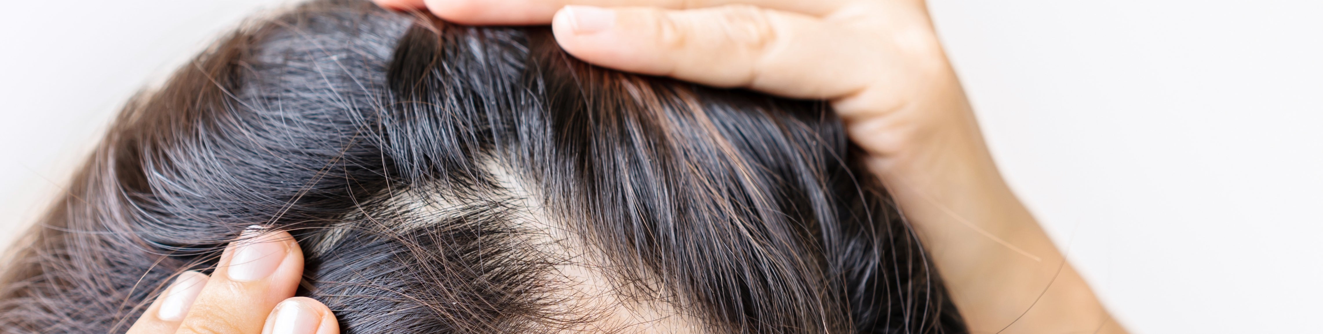 La chute de cheveux chez la femme