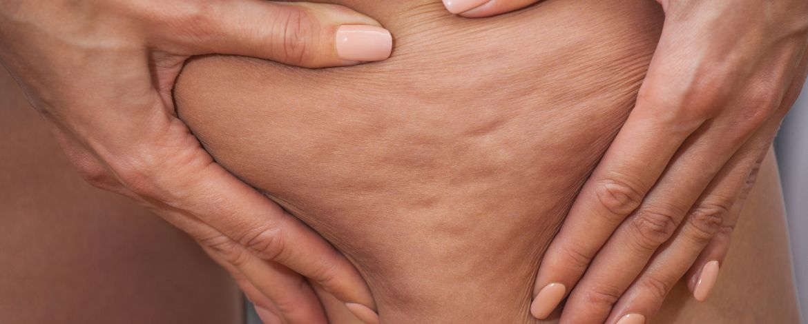 Conseils et solutions pour réduire l’aspect de la cellulite aux cuisses