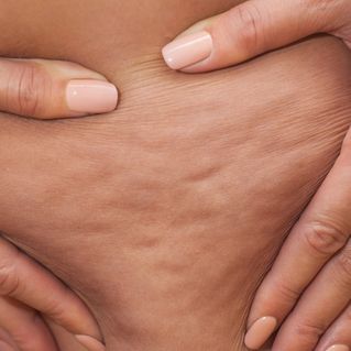Cellulite 
