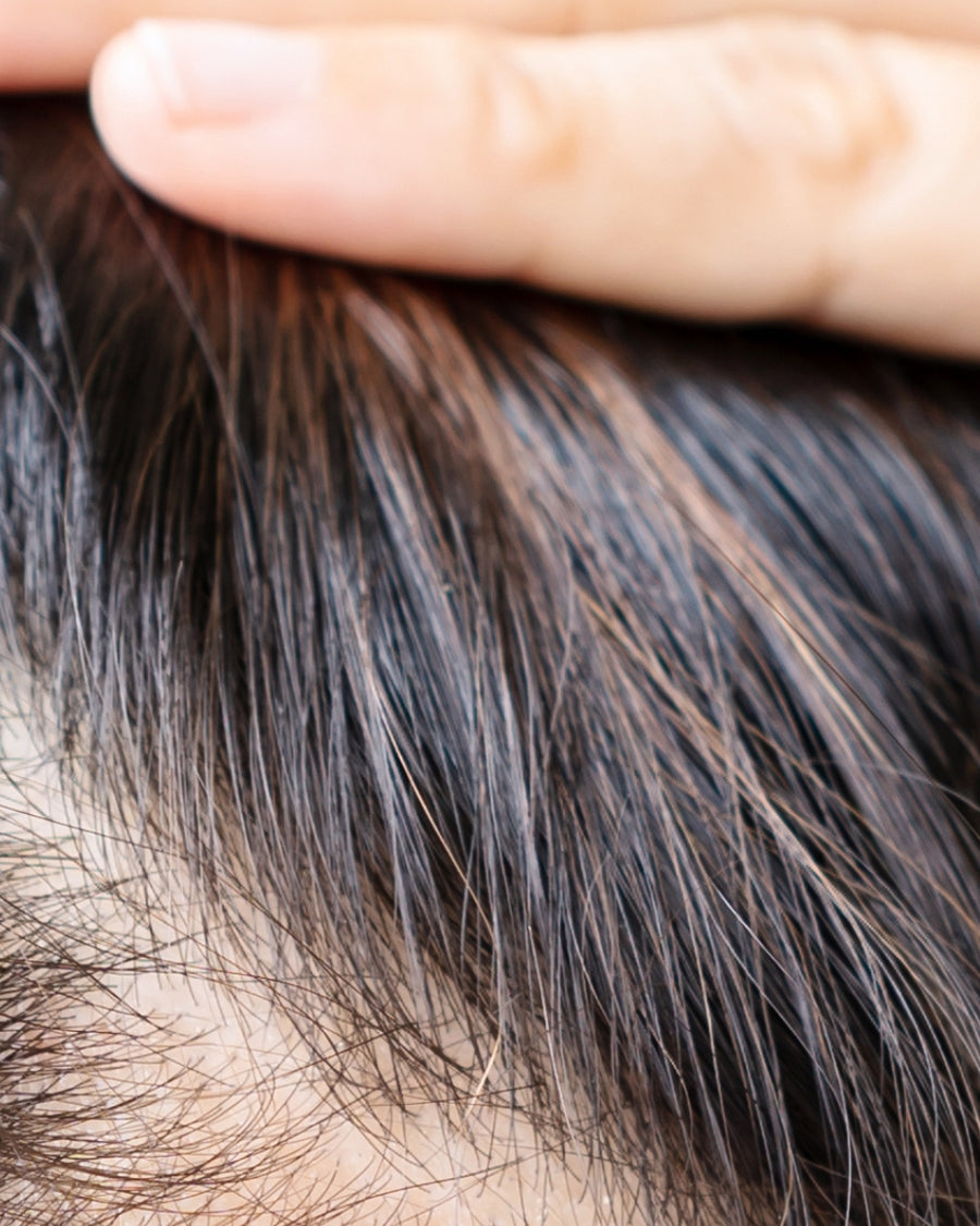 La chute de cheveux chez la femme